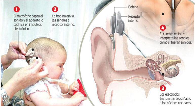 implante-coclear-info-1
