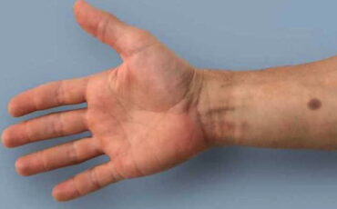 tatuaje para diagnostico